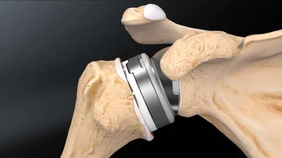 SHOULDER REPLACEMENT