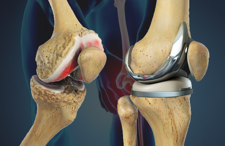 KNEE REPLACEMENT